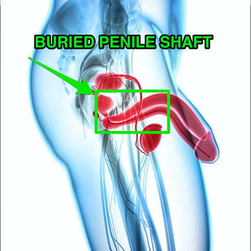 Penis pump tips