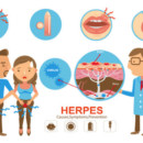 Herpes Management Plan