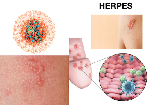 Herpes Virus