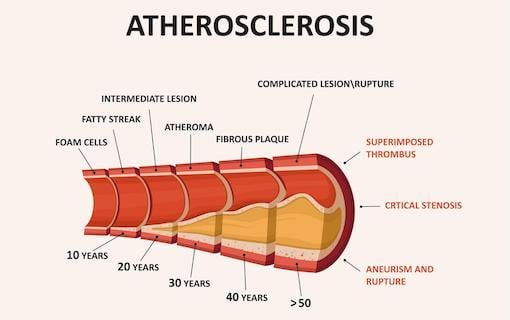 https://personallifemedia.com/wp-content/uploads/2019/06/Atherosclerosis.jpg